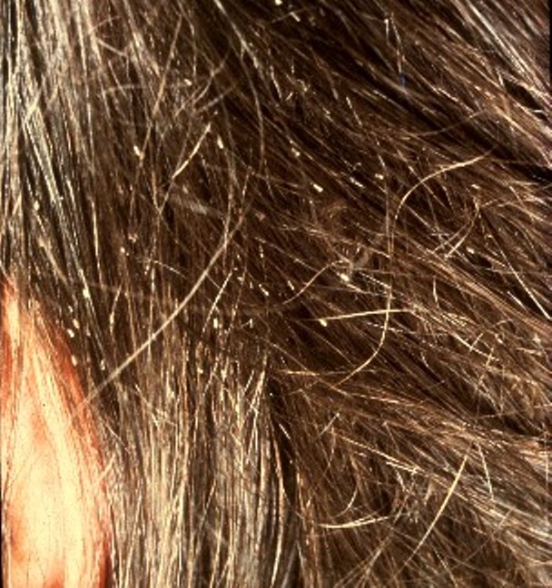 Head lice- nits